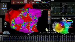 Left atrial flutter ablation par le Dr Franck Halimi Rythmologue Paris [upl. by Okiam]