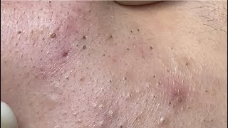 Acne treatment for Spa Linh Mun 2023 003 [upl. by Ahtilat]