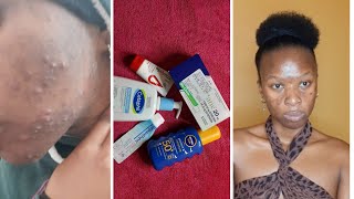 Oratane 3months Review Clearing my Acne Athayabulela  South African YouTuber acnetreatment [upl. by Carola]