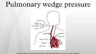 Pulmonary wedge pressure [upl. by Serena971]