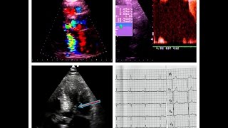 Hypertrophic Cardiomyopathy The ECG echocardiography and treatment [upl. by Cohleen897]