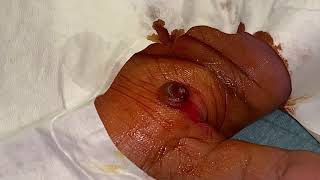 removal of granuloma from a hand [upl. by Noiraa]