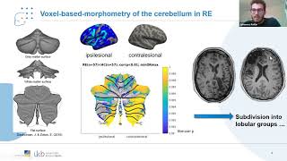 Talk Volumetric analysis reveals bilateral cerebellar atrophy in Rasmussen encephalitis [upl. by Cymbre]