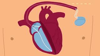 Implantation dun stimulateur cardiaque au Centre de cardiologie de lHôpital universitaire de Bâle [upl. by Matheny]