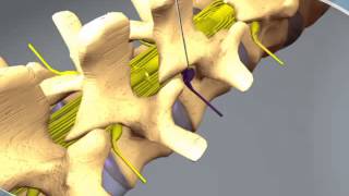 What to expect during a Nerve Root Block at RAYUS [upl. by Htebasyle]