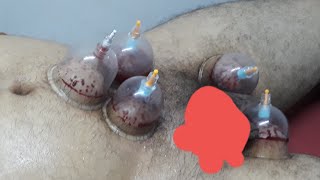 avascular necrosis treatment 9724117806 cupping therapy in ahmedabad [upl. by Schlicher]