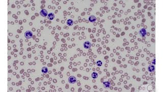 Chronic Neutrophilic Leukemia CNL [upl. by Reuven797]