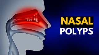 NASAL POLYPS Causes SIgns and Symptoms Diagnosis and Treatment [upl. by Lyudmila]