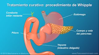 Cáncer de páncreas tratamiento y resultados [upl. by Araik]