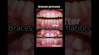 braces process braces transformation braces orthodontist dentist shorts viral [upl. by Afatsum]