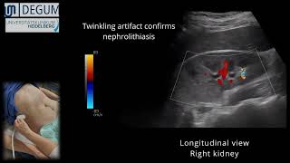 Episode 39 NephroUrolithiasis [upl. by Giraldo577]