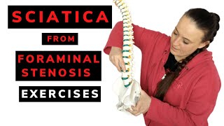 Sciatica from foraminal stenosis  exercises [upl. by Nrehtak966]