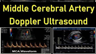 Middle Cerebral Artery Doppler Ultrasound Interpretation  Ultrasound in Fetal Growth Assessment [upl. by Tnahsarp]