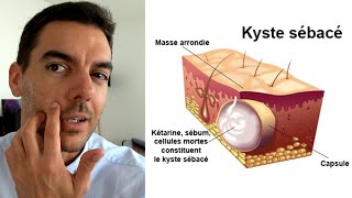 Kyste Sébacé  Mon Expérience  Causes Infection Traitement Opération [upl. by Sherrill]