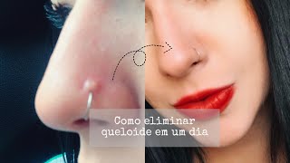 Como acabar com a queloide do piercing  Sharon Mel [upl. by Acirdna]