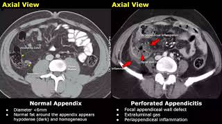 Appendix CT Scan Normal Vs Appendicitis Images  Acute Gangrenous Types amp Perforated Appendix [upl. by Yssep]