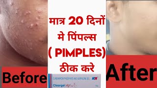 pimples soap  pimples cream  pimples  pimples short  pimples removal on face at homepimples gel [upl. by Teillo10]