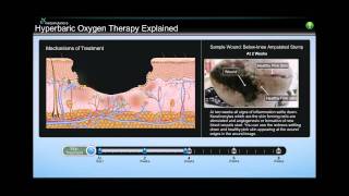 Patient Education Simulation for Hyperbaric Oxygen Therapy [upl. by Haididej333]