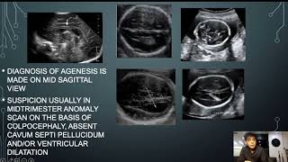 PITFALLS IN DIAGNOSIS OF AGENESIS OF CORPUS CALLOSUM [upl. by Nosyarg]