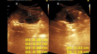 Hydro nephrosis Infant Kidney  Dilated Renal Pelvis [upl. by Ury384]