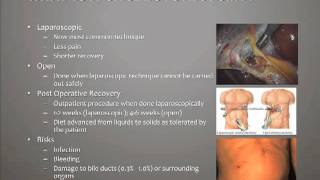 What is a Cholecystectomy [upl. by Maryjo]