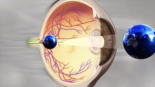 Lente Intraocular opacoCapsulotomía Yag LaserOpacidad de Cápsula Posterior [upl. by Sacul307]