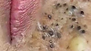 Blackheads amp Whiteheads Satisfying Removal 0260 [upl. by Ma168]