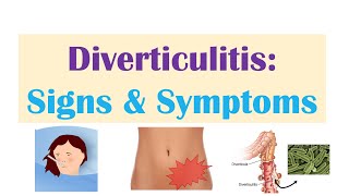 Diverticulitis Signs amp Symptoms And Why They Occur [upl. by Musihc]