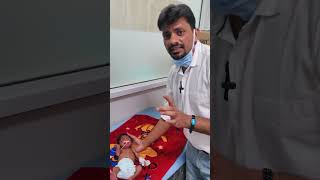 polydactyly syndactyly and dolichocephaly  a case demonstration [upl. by Ayn]