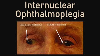 Internuclear Ophthalmoplegia [upl. by Nohsid185]