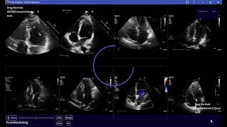 Ranking A4C echo videos based on the level of Foreshortening [upl. by Otrebire]