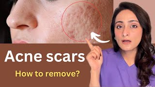 How to reduce Acne Scar  Chemical peels Dermaroller Lasers  Cost  Dermatologist Dr Aanchal [upl. by Ileak788]