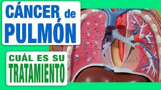 Cáncer de Pulmón  Tratamiento [upl. by Nyrual]