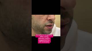 Acneiform Eruptions  Say no to steroid creams Dr Ashima Goel MD dermatologist [upl. by Ayim]