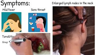 Infectious mononucleosis  Easy explained [upl. by Alvy769]