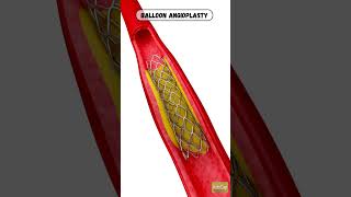 Balloon angioplasty  angioplasty  central vein balloon angioplasty  Angioplasty animation [upl. by Eignav]