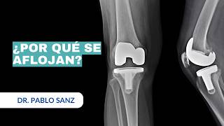 ¿Por qué se AFLOJAN las PRÓTESIS DE RODILLA 🚨 Descubre las Causas y Soluciones Aquí [upl. by Marja]