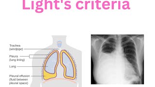 Pleura  Pleural effusion  Lights criteria  Transudate  Exudate Empyema [upl. by Anuhsal]