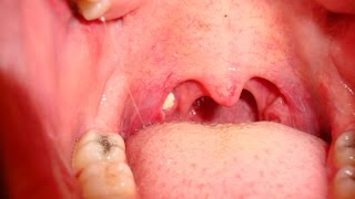 Tonsil Stones  How to Remove Tonsil Stones [upl. by Holden]