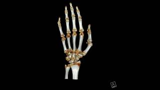 4th and 5th Metacarpal base fracture [upl. by Christophe658]