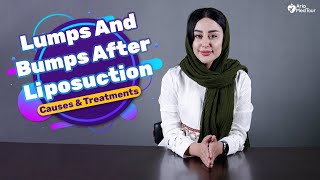 How to Get Rid of Lumps After Liposuction  AriaMedTour [upl. by Haianeb967]