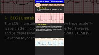 Ischemic Heart Disease Series2 Stable amp Unstable Angina [upl. by Aseiram]