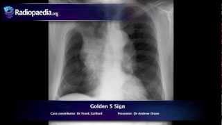 Golden S sign  radiology video tutorial xray [upl. by Christianson]