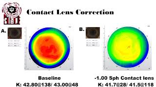 Anisometropia and Aniseikonia Treatment [upl. by Iroj]