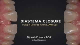 Diastema Closure Perfection  Using a modified matrix approach [upl. by Florian703]