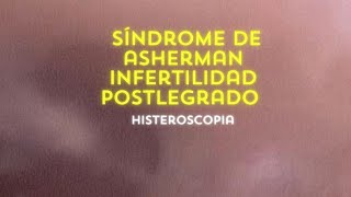 Síndrome de Asherman  Infertilidad Post legrado Histeroscopia [upl. by Aurlie]