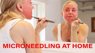 Microneedling DIY at Home  Tips Warnings and Demo  Over 50 [upl. by Elkcim952]