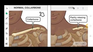 CLEIDOCRANIAL DYSPLASIA  IN JUST 5 MINUTES  SIMPLE AND EASY [upl. by Karsten]