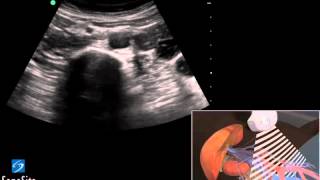 3D Lehrvideo Ultraschalluntersuchung der Aorta Abdominal  SonoSite Ultraschall [upl. by Meldoh869]