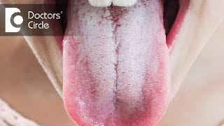 Is Oral thrush contagious  Dr Jayaprakash Ittigi [upl. by Gwenny]